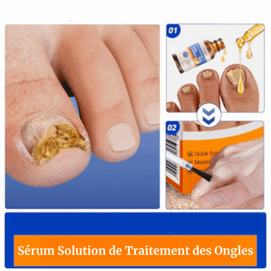 Adieu Aux Mycoses Des Ongle en 7 Jours Avec Notre Sérum Solution De Traitement Des Ongles