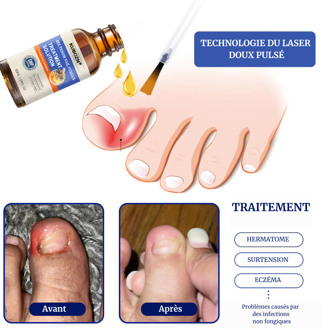 Adieu Aux Mycoses Des Ongle en 7 Jours Avec Notre Sérum Solution De Traitement Des Ongles